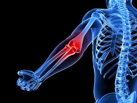 Bone pain deals in arm